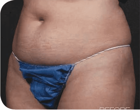 Fat Melting Patient 09 Before