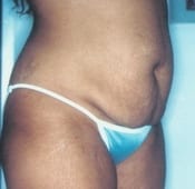 Tummy Tuck (Abdominoplasty) Patient 01 Before