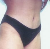 Tummy Tuck (Abdominoplasty) Patient 01 After
