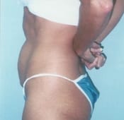 Tummy Tuck (Abdominoplasty) Patient 02 Before