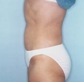 Tummy Tuck (Abdominoplasty) Patient 02 After