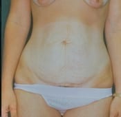 Tummy Tuck in Southern California Before Patient 3