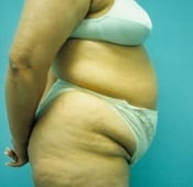 Tummy Tuck in Southern California Before Patient 2