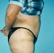Tummy Tuck in Southern California After Patient 2