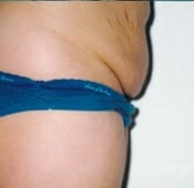 Tummy Tuck in Southern California Before Patient 1