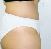 Tummy Tuck in Southern California After Patient 1