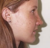 Nose Surgery (Rhinoplasty) Patient 01 After