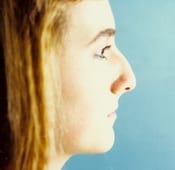 Nose Surgery (Rhinoplasty) Patient 02 Before