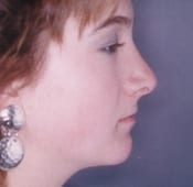 Nose Surgery (Rhinoplasty) Patient 02 After