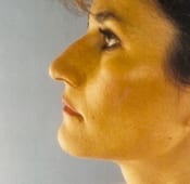 Nose Surgery (Rhinoplasty) Patient 03 Before