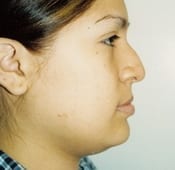 Nose Surgery (Rhinoplasty) Patient 05 Before