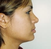 Nose Surgery (Rhinoplasty) Patient 05 After