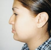 Nose Surgery (Rhinoplasty) Patient 05 Before - 2