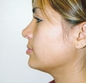 Nose Surgery (Rhinoplasty) Patient 05 After - 2