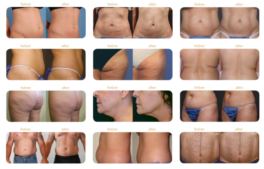 nonsurgical body contouring before and after photo collage