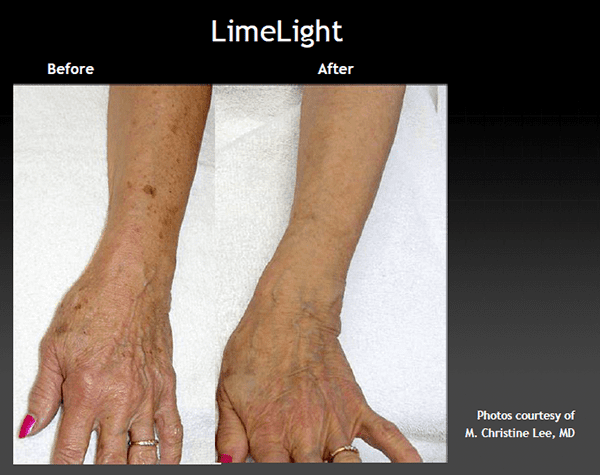 Before and after hand rejuvenation treatment - patient 3