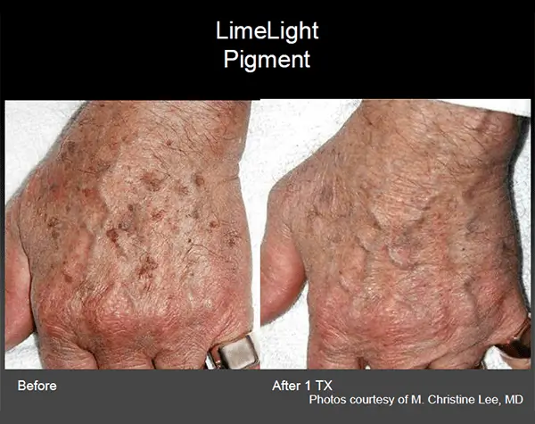 Before and after hand rejuvenation treatment - patient 1