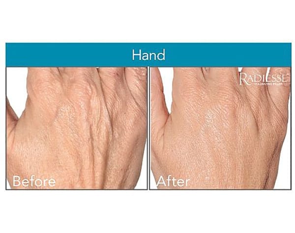 Before and after hand rejuvenation treatment - patient 2