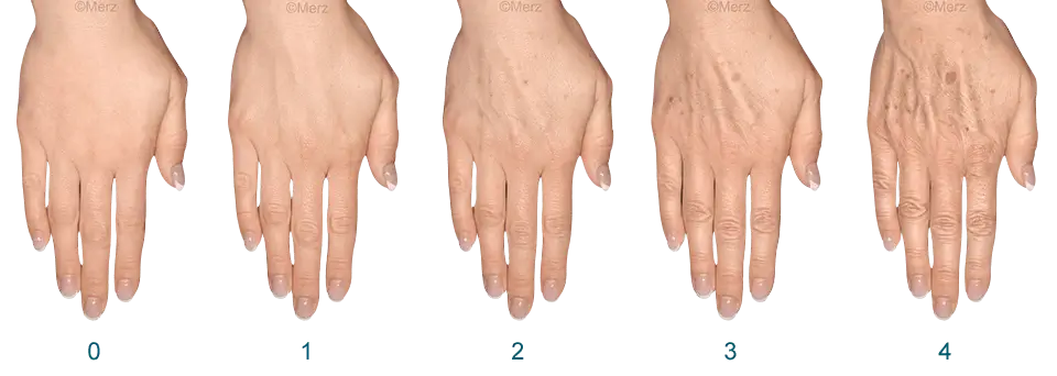 Before and after hand rejuvenation treatment - patient 4