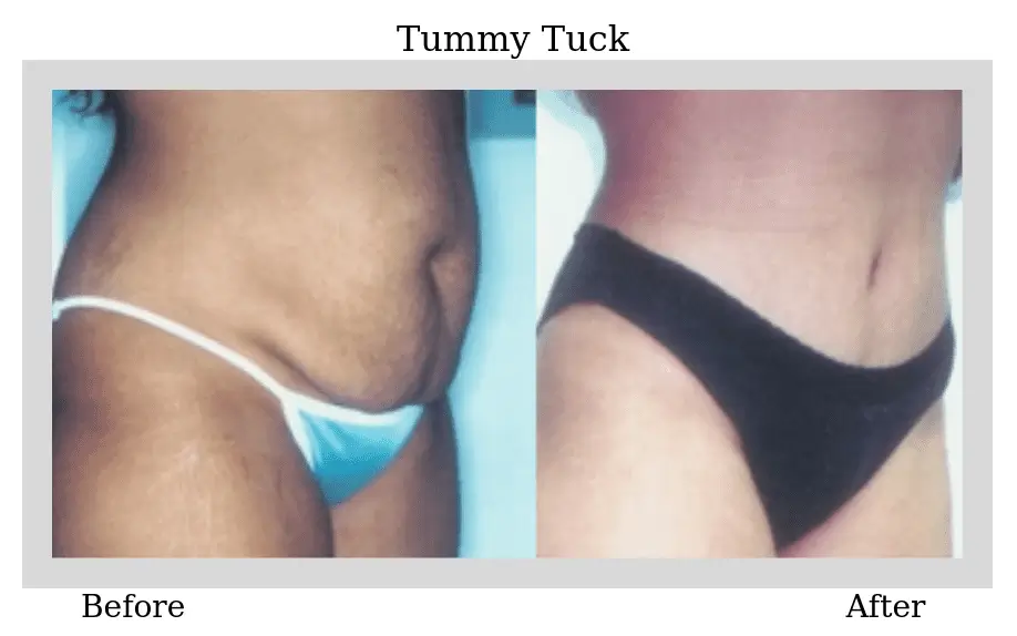 Before and After Tummy Tuck Surgery photo