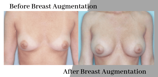 Before and After Breast Augmentation