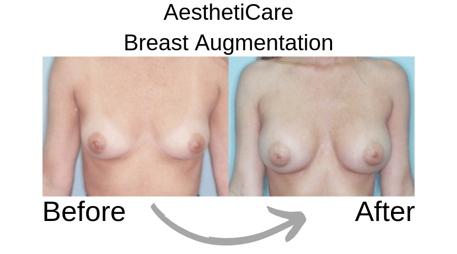 Breast augmentation before and after