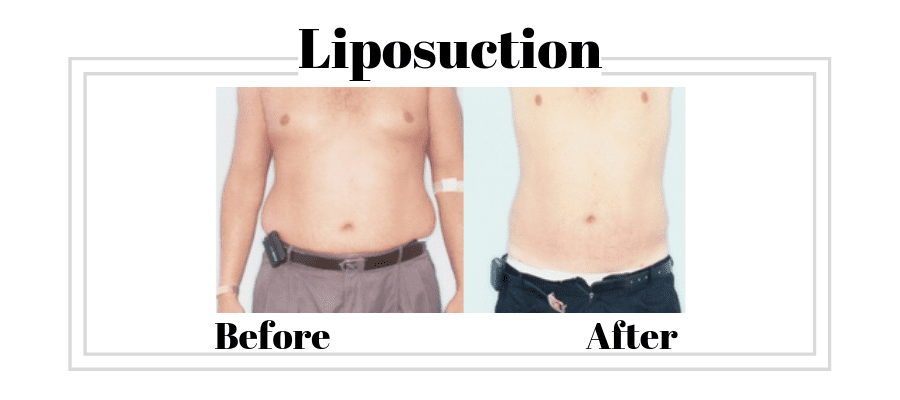 Liposuction patient before and afters