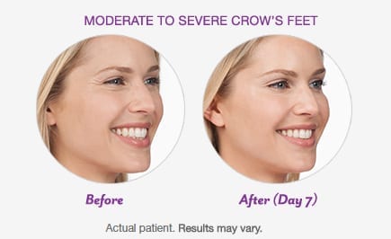 BOTOX® Cosmetic Before Patient 1