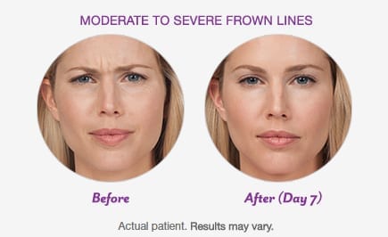 BOTOX® Cosmetic in Orange County After Patient 1