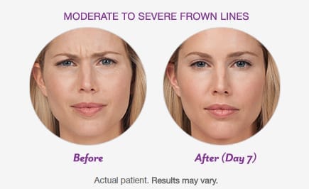 BOTOX® Cosmetic After Patient 1