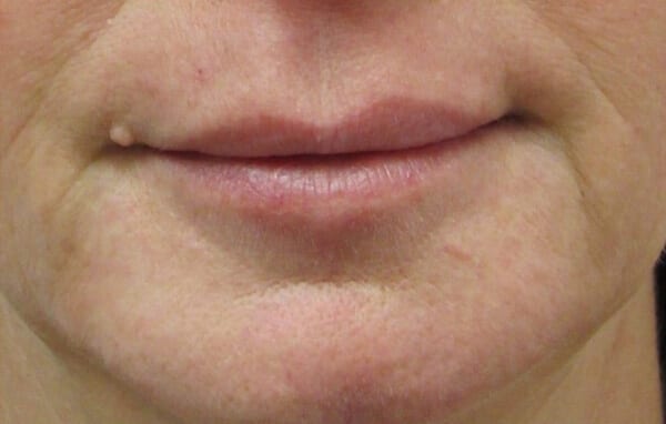 Fillers Patient 02 Before