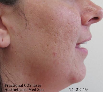 Fractional CO2 Patient 01 After