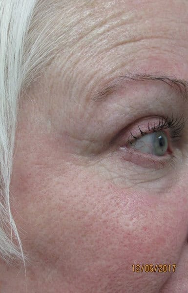 Fractional CO2 Patient 02 After