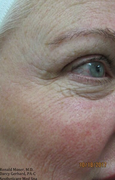 Fractional CO2 Patient 02 Before