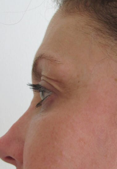 Fractional CO2 Patient 03 After