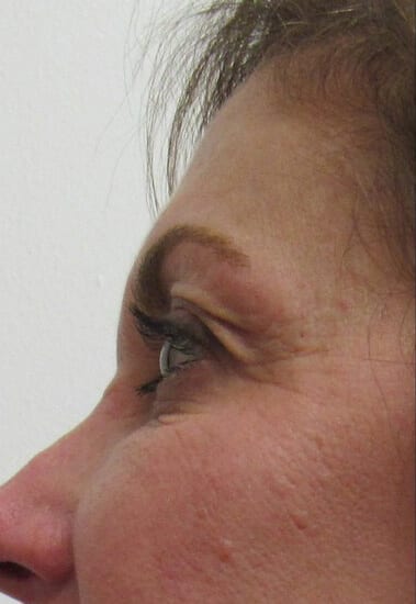 Fractional CO2 Patient 03 Before
