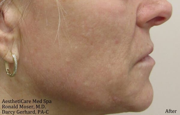 Fractional CO2 Patient 04 After