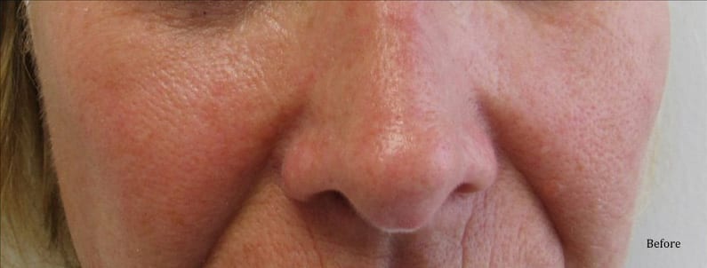 IPL Patient 01 Before