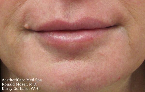 Fillers Patient 02 After