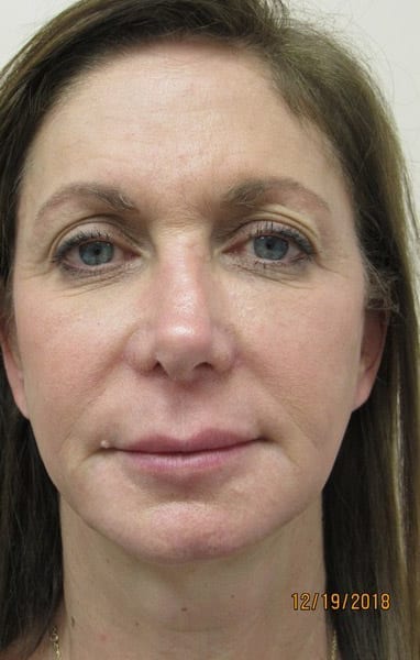 PDO Thread Patient 01 After