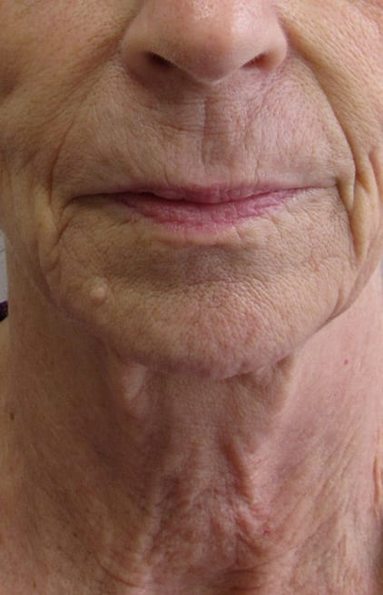 PDO Thread Patient 02 Before