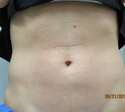 TruSculpt Patient 01 After