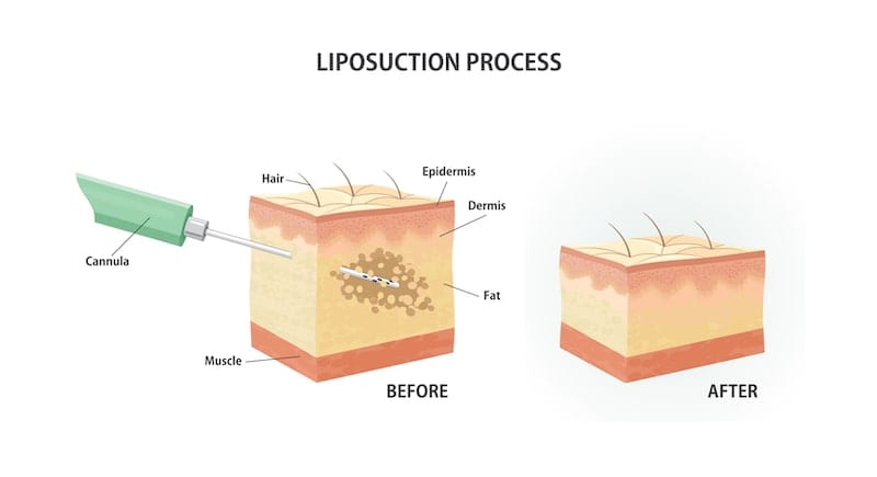 Illustration demonstrating how liposuction is performed.