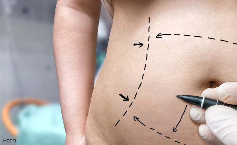 Woman in a tummy tuck consultation with surgical lines drawn on abdomen
