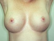 Breast Augmentation Patient 06 After