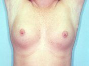 Breast Augmentation Patient 06 Before