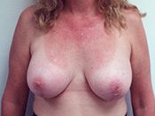 Breast Lift Patient 06 After