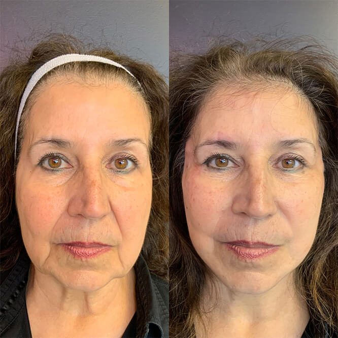 Before and after results of a female patient
