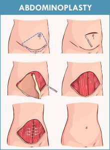 Illustration of abdominoplasty.