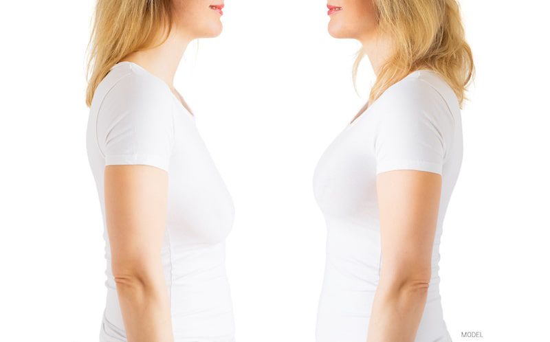 A before and after photo of a woman who had a breast lift.